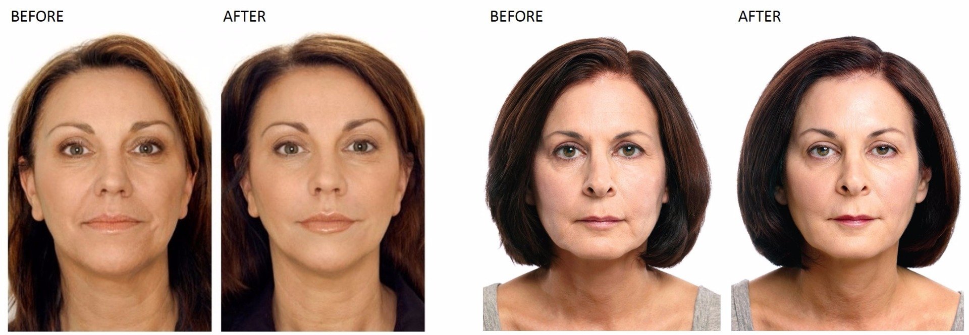Botox and Cosmetic Injections at Total Body Care Botox and Cosmetic Injections at Total Body Care