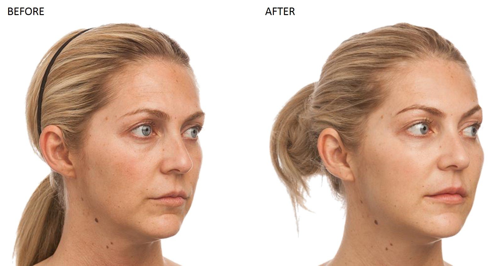 Dermal Fillers at Total Body Care