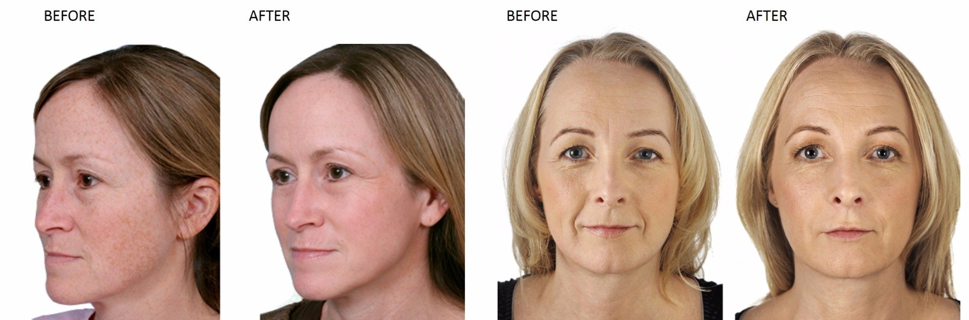 Laser Skin Rejuvenation at Total Body Care Laser Skin Rejuvenation at Total Body Care