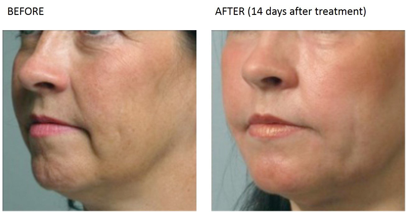 Laser Skin Rejuvenation at Total Body Care Laser Skin Rejuvenation at Total Body Care