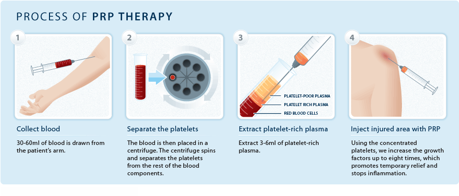 PRP Therapy at Total Body Care PRP Therapy at Total Body Care