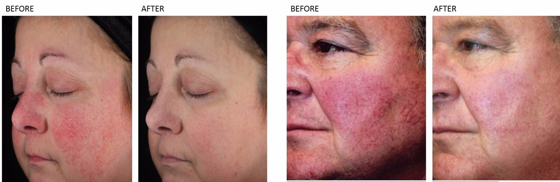 Rosacea Treatment at Total Body Care Rosacea Treatment at Total Body Care