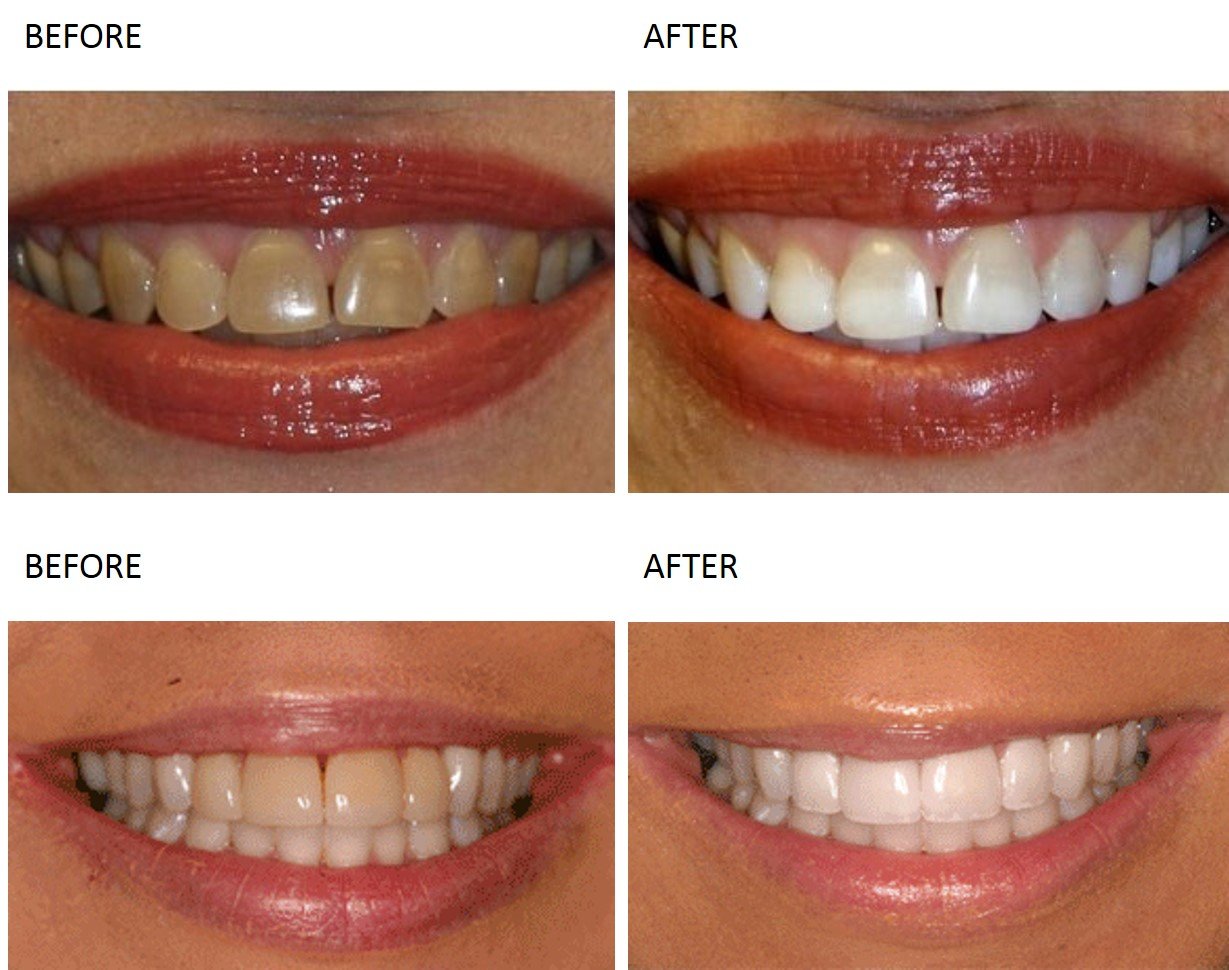 Teeth Whitening at Total Body Care