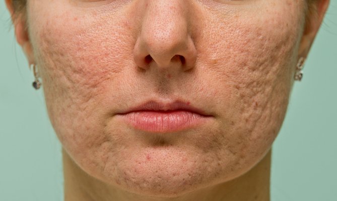 Acne and Acne Scar Treatment at Total Body Care Acne and Acne Scar Treatment at Total Body Care